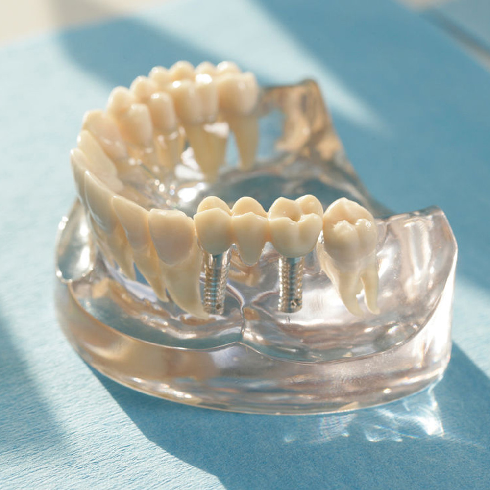 Implantologie Zahnarztpraxis Implantate Ammersee